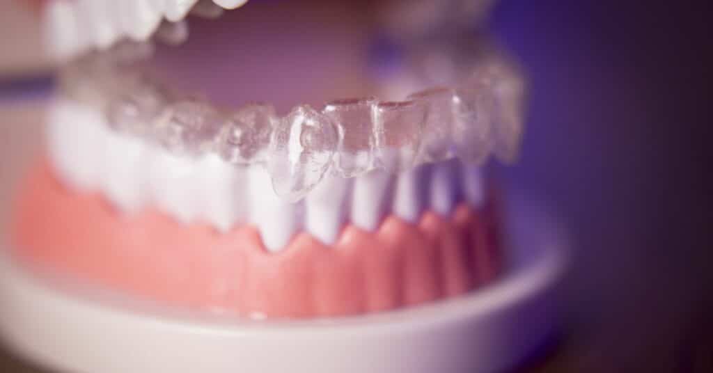 יתרונות של יישור שיניים שקוף
